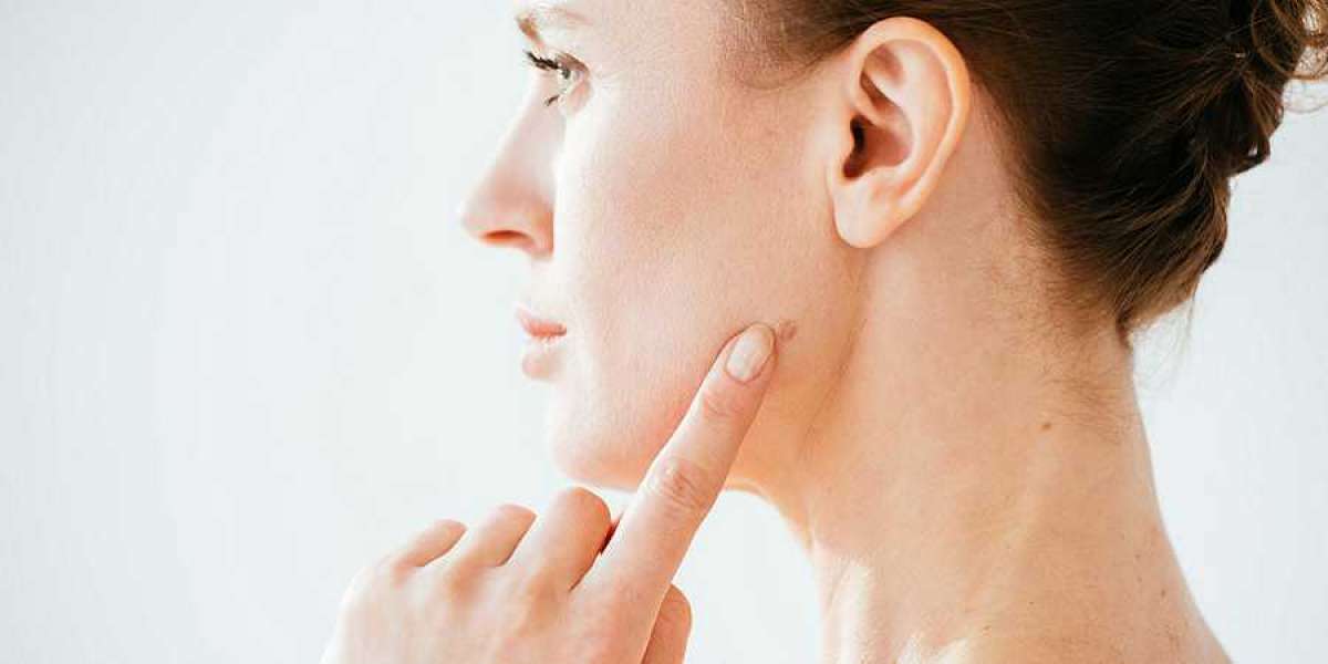 Riyadh's Mole Removal Revolution Your Ticket to Clearer Skin