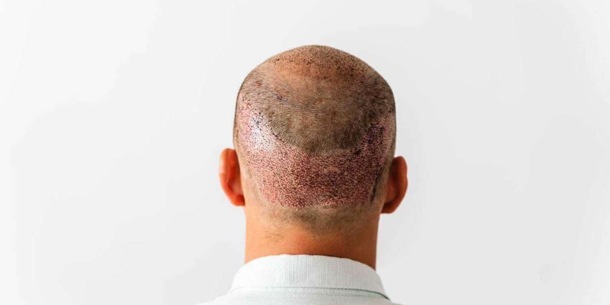 What to Expect Before and After a Hair Transplant in Riyadh