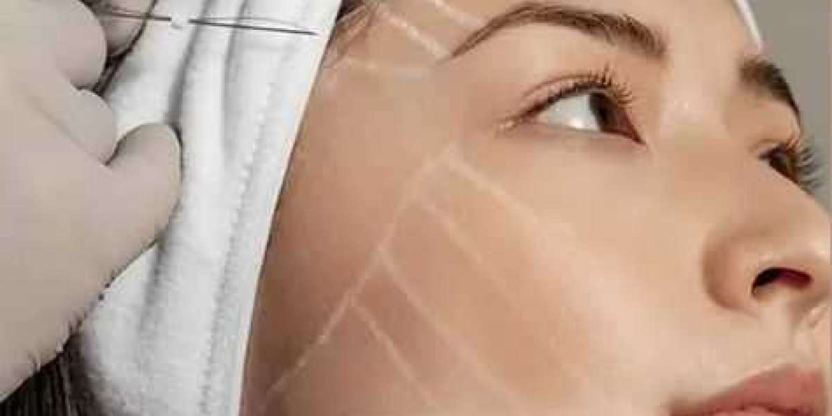 Rejuvenate Your Appearance with Thread Lift Procedures in Islamabad